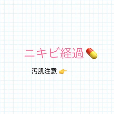 ニキビ治療を始めてから
大体7ヶ月ほど経ったので久々にお肌の様子を載せていきたいと思います。

⭐️現在はヒルドイドローション、ディフェリン、ナジフロキサシンのみを使っています。
冬は空気が乾燥している