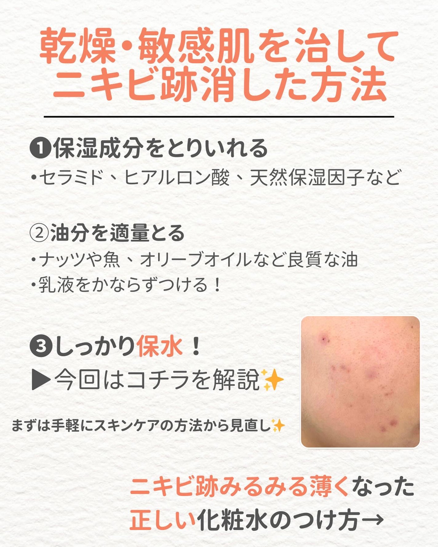 ニキビを諦めかけた人の味方|エマ🫧 on LIPS 「【始めましてのあなたへ✨】「私は一緒肌治らないのかな…」と過去..」(5枚目)