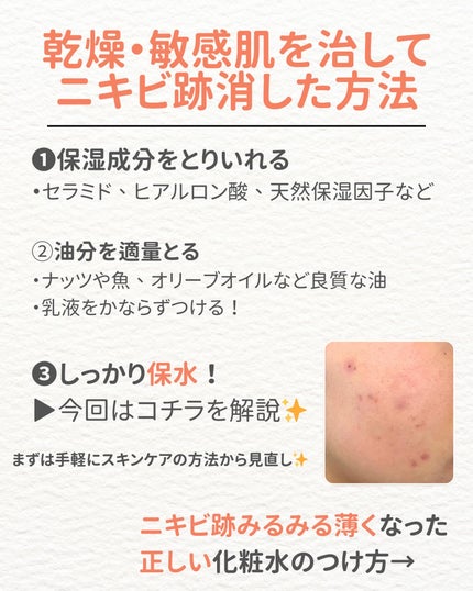ニキビを諦めかけた人の味方|エマ🫧 on LIPS 「【始めましてのあなたへ✨】「私は一緒肌治らないのかな…」と過去..」(5枚目)