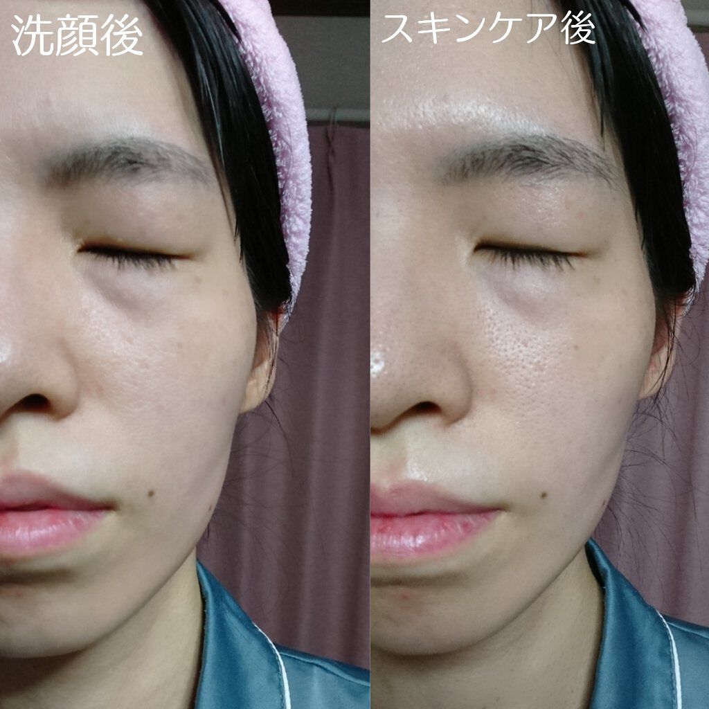 スーパーホワイトEXスタートセット/ドクターリセラ/トライアルキットを使ったクチコミ(10枚目)