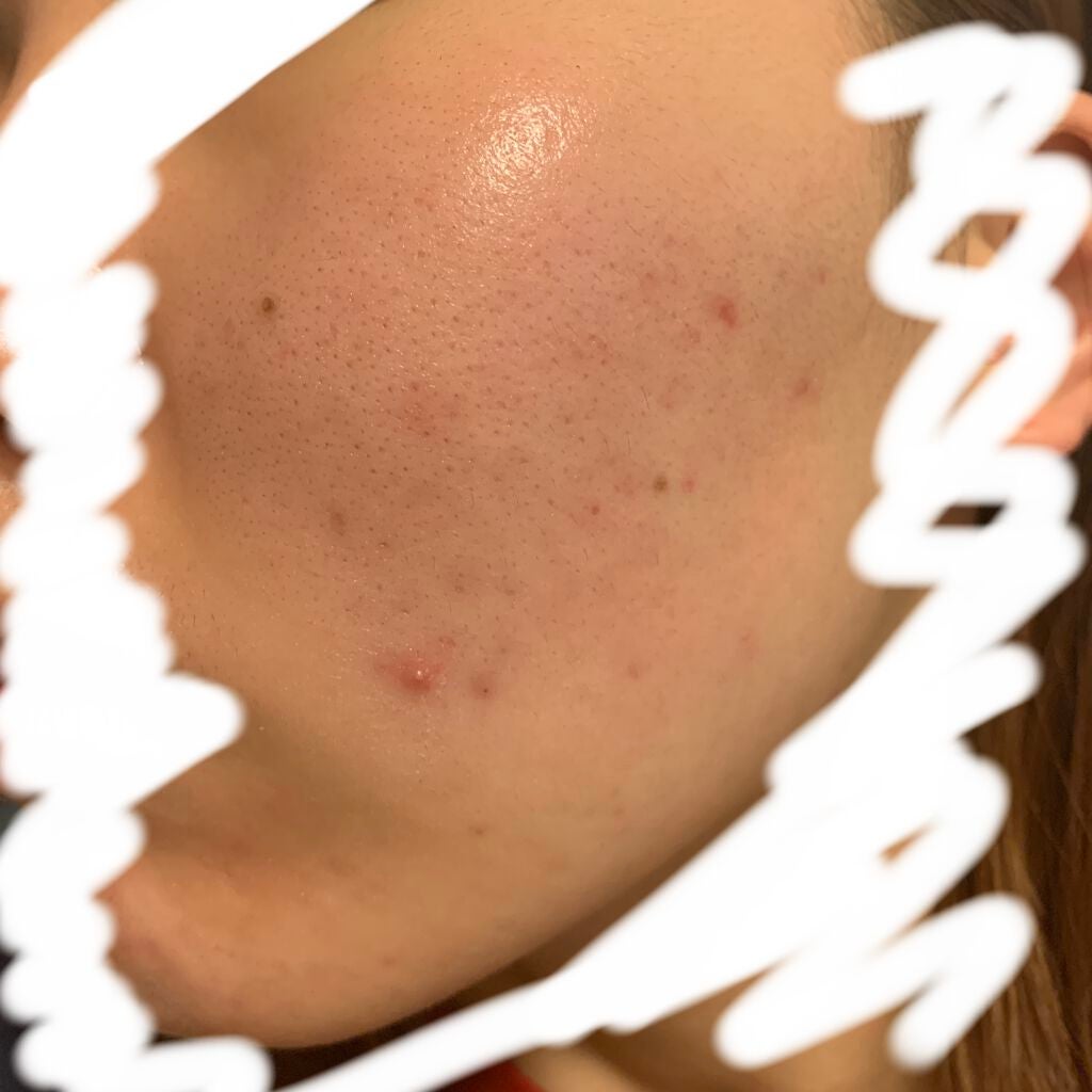 経過観察するよ on LIPS 「最近は、赤み取りに、メラノcc美容液を使ってる朝と夜、朝は、洗..」(1枚目)