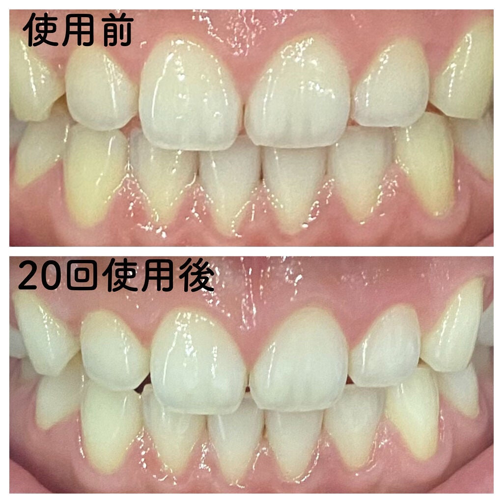 クレスト3Dホワイトニング ホワイトストリップ プロフェッショナル エフェクツ/クレスト/その他オーラルケアを使ったクチコミ(2枚目)