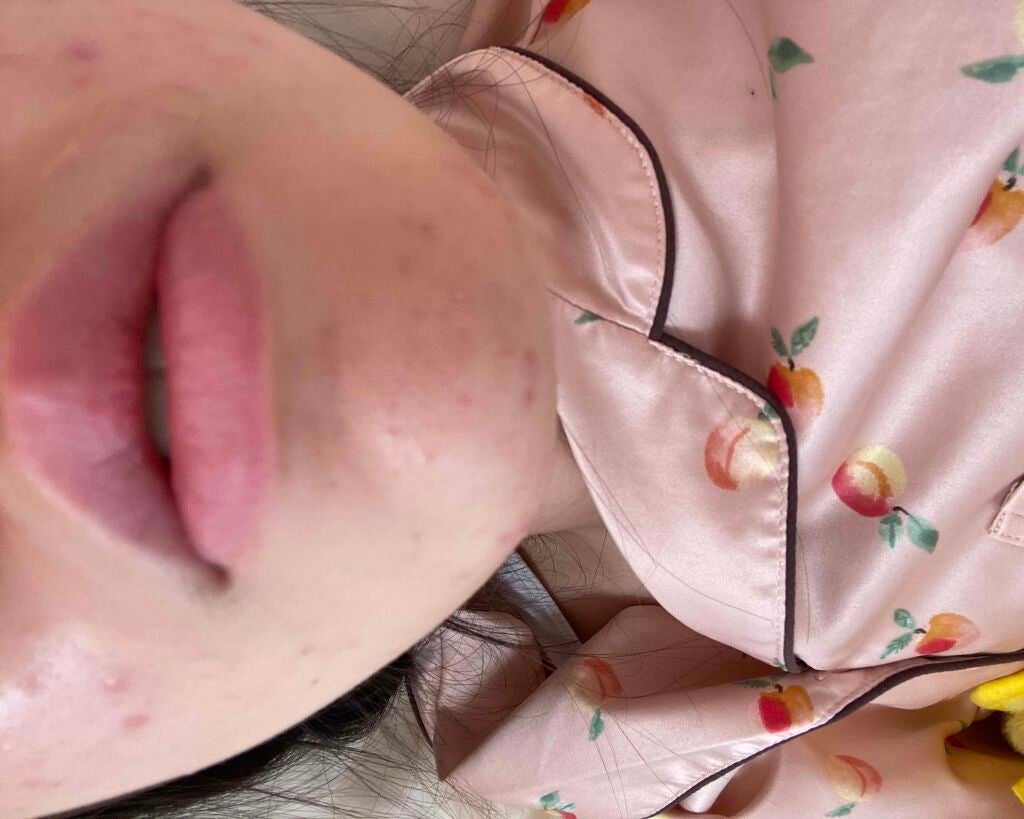 mo on LIPS 「ニキビ治りません皮膚科に行ってもダメでした色んな薬使いましたが..」(4枚目)