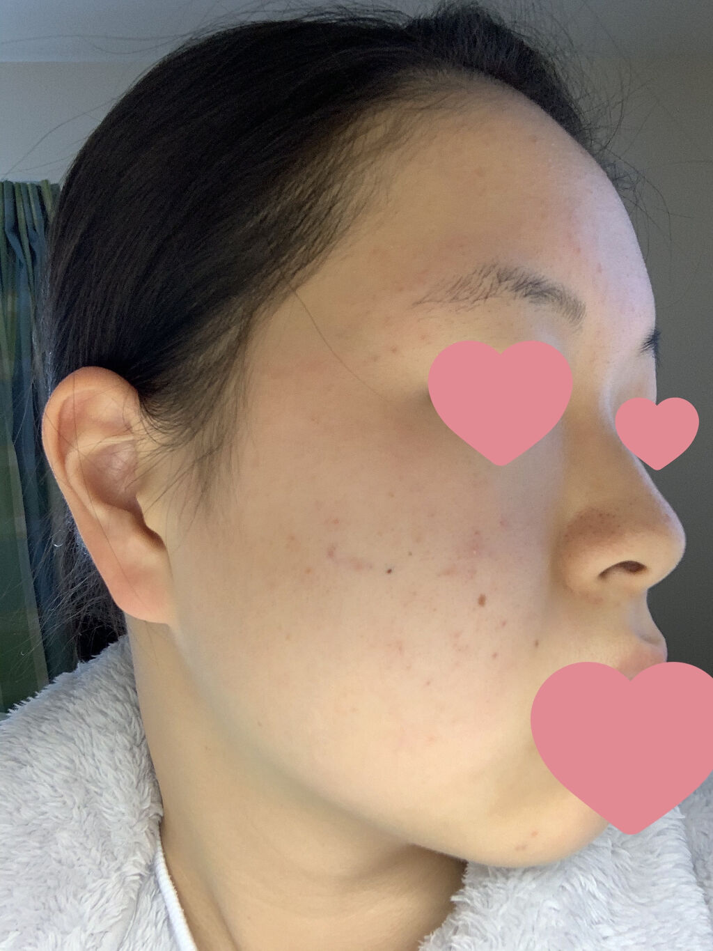 ペアアクネクリームW(医薬品)/ペア/その他を使ったクチコミ（3枚目）