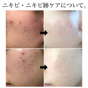 スキンケア方法 白潤 薬用美白化粧水 肌ラボの使い方 効果 長年悩まされたニキビ By きつね 乾燥肌 代後半 Lips