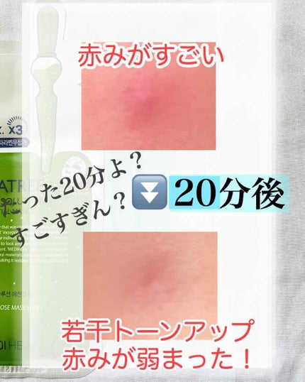 ティーツリーケアソリューション アンプルマスクJEX/MEDIHEAL/シートマスク・パックを使ったクチコミ(2枚目)