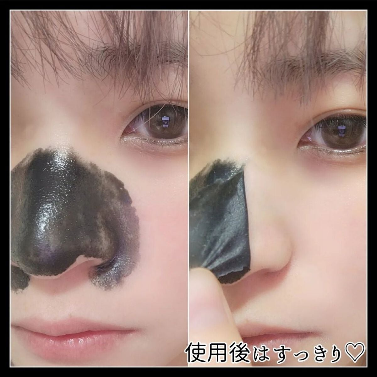 毛穴小町 ブラックピールオフパック/クリアターン/ピーリングを使ったクチコミ(6枚目)