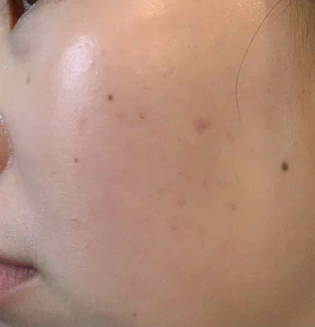 TOUT VERT クリスタルパウダーのクチコミ「生理前になるとやっぱりできるよね〜

あと、これでニキビ跡が何日で消えた！

とかあるけど本当.....」（2枚目）