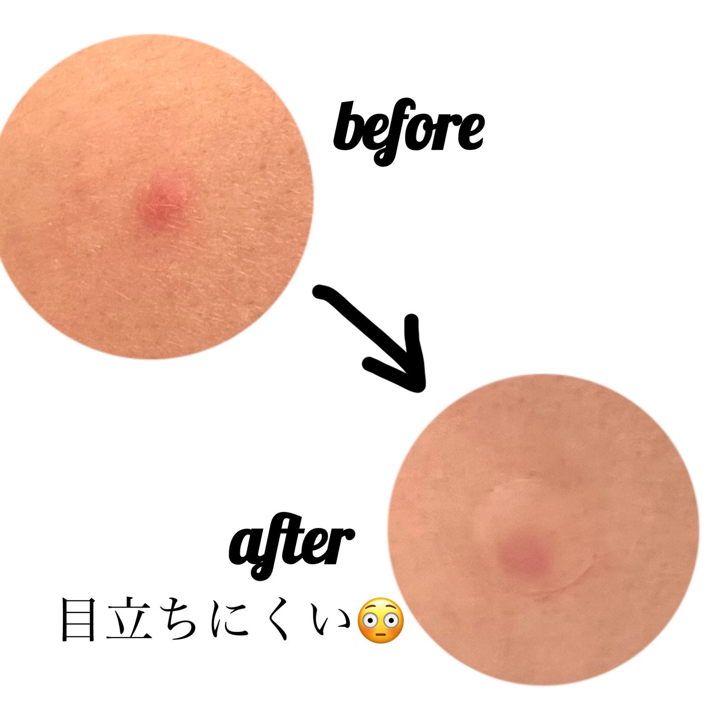 プロCICA クリアスポットパッチ/VT/その他スキンケアを使ったクチコミ(3枚目)