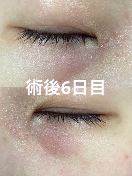 みっすん on LIPS 「目の下のポツポツをアグネスで治療してみた───────────..」(6枚目)