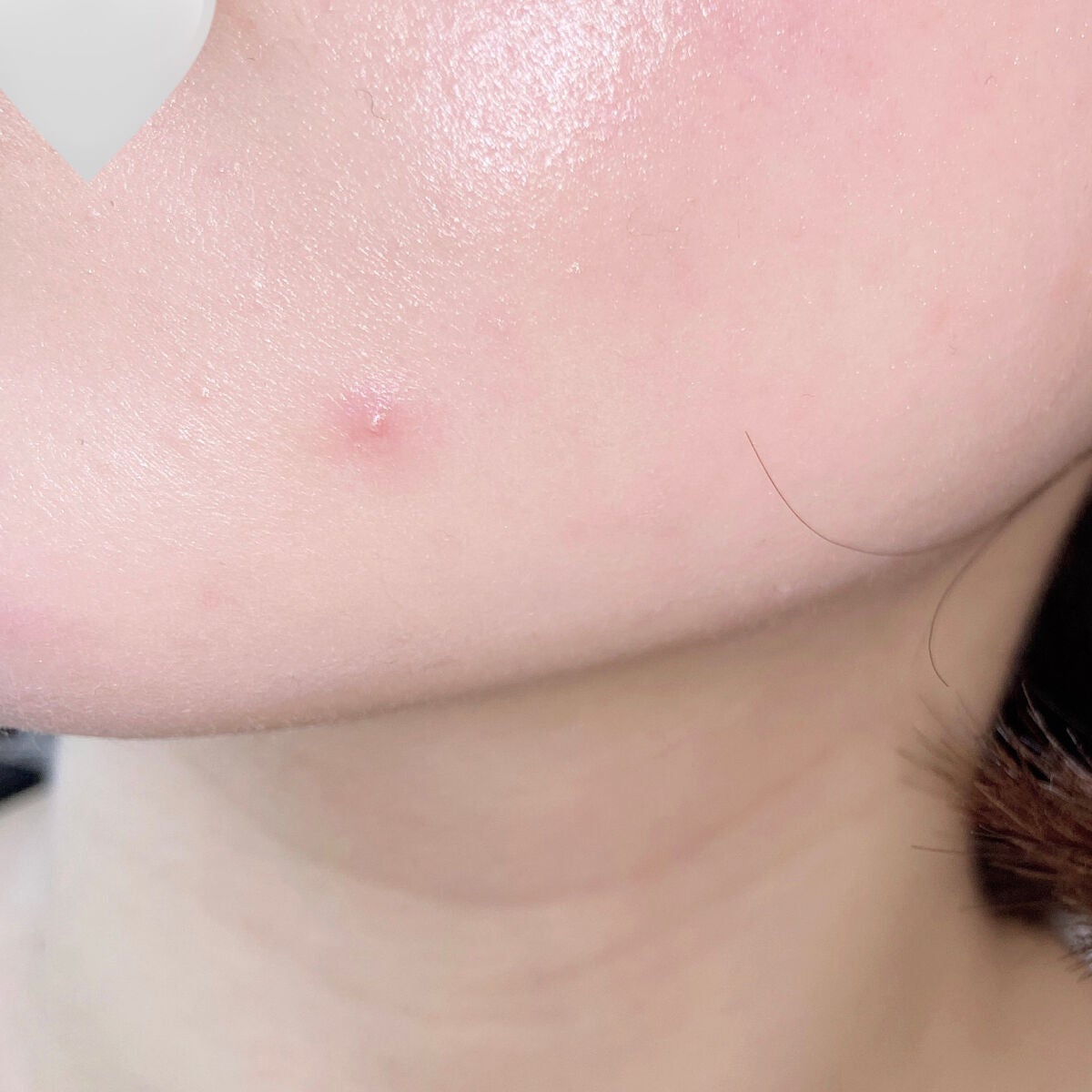 はるかの美容垢🐰 on LIPS 「ここ最近お肌の調子よかったからニキビなかったんだけど、朝起きた..」(1枚目)