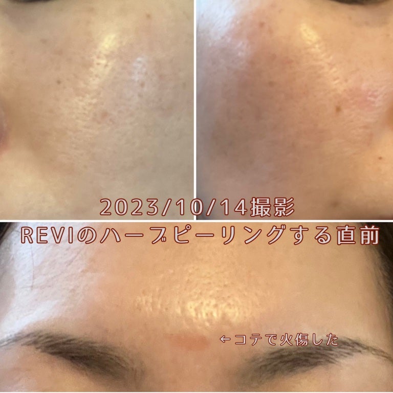 Rifa on LIPS 「※観覧注意⚠️肌載せてます。最近話題のREVIのハーブピーリン..」(2枚目)