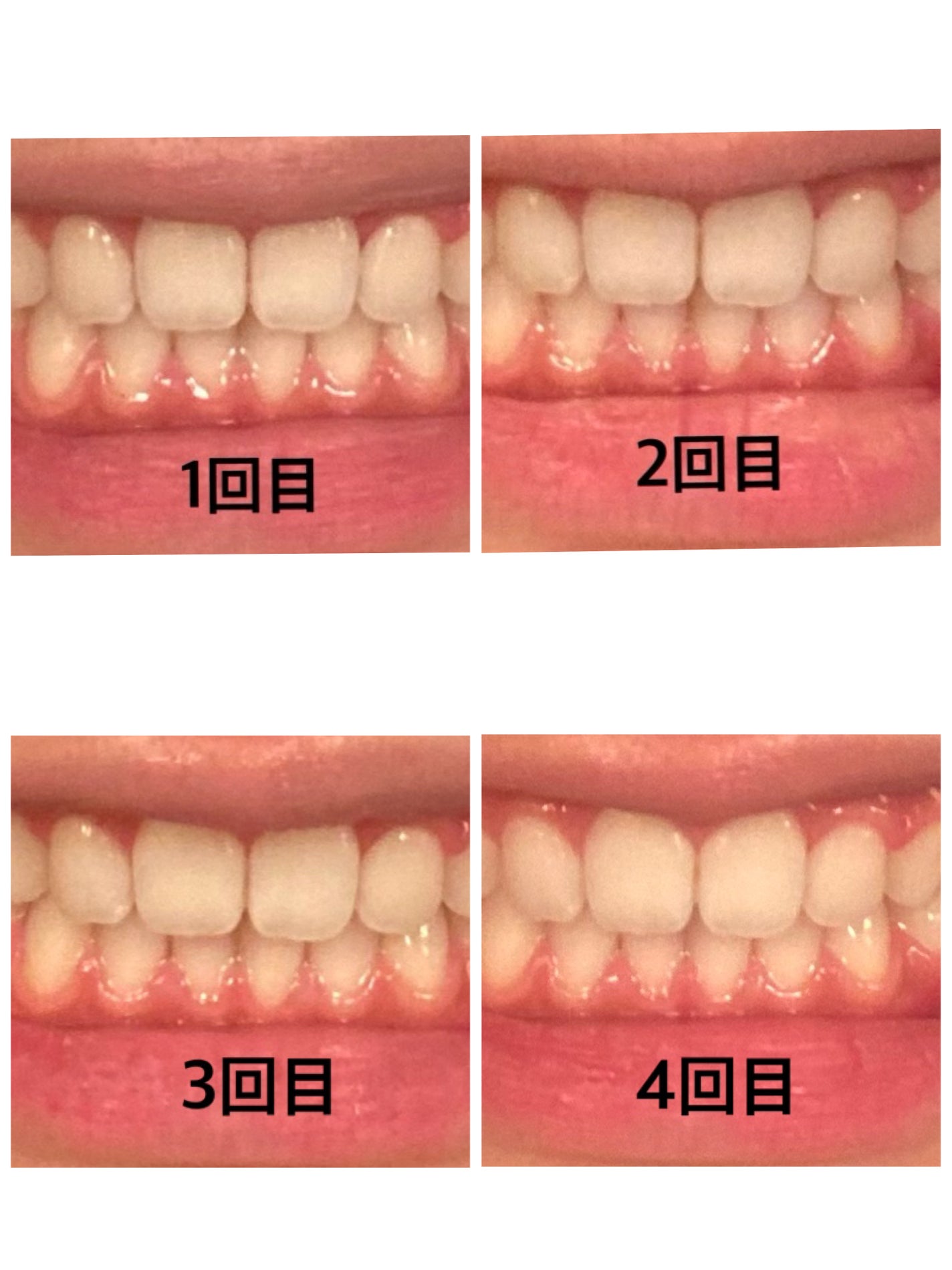 歯磨き堂 薬用ホワイトニングペースト プレミアム/歯磨き堂/歯磨き粉を使ったクチコミ(3枚目)