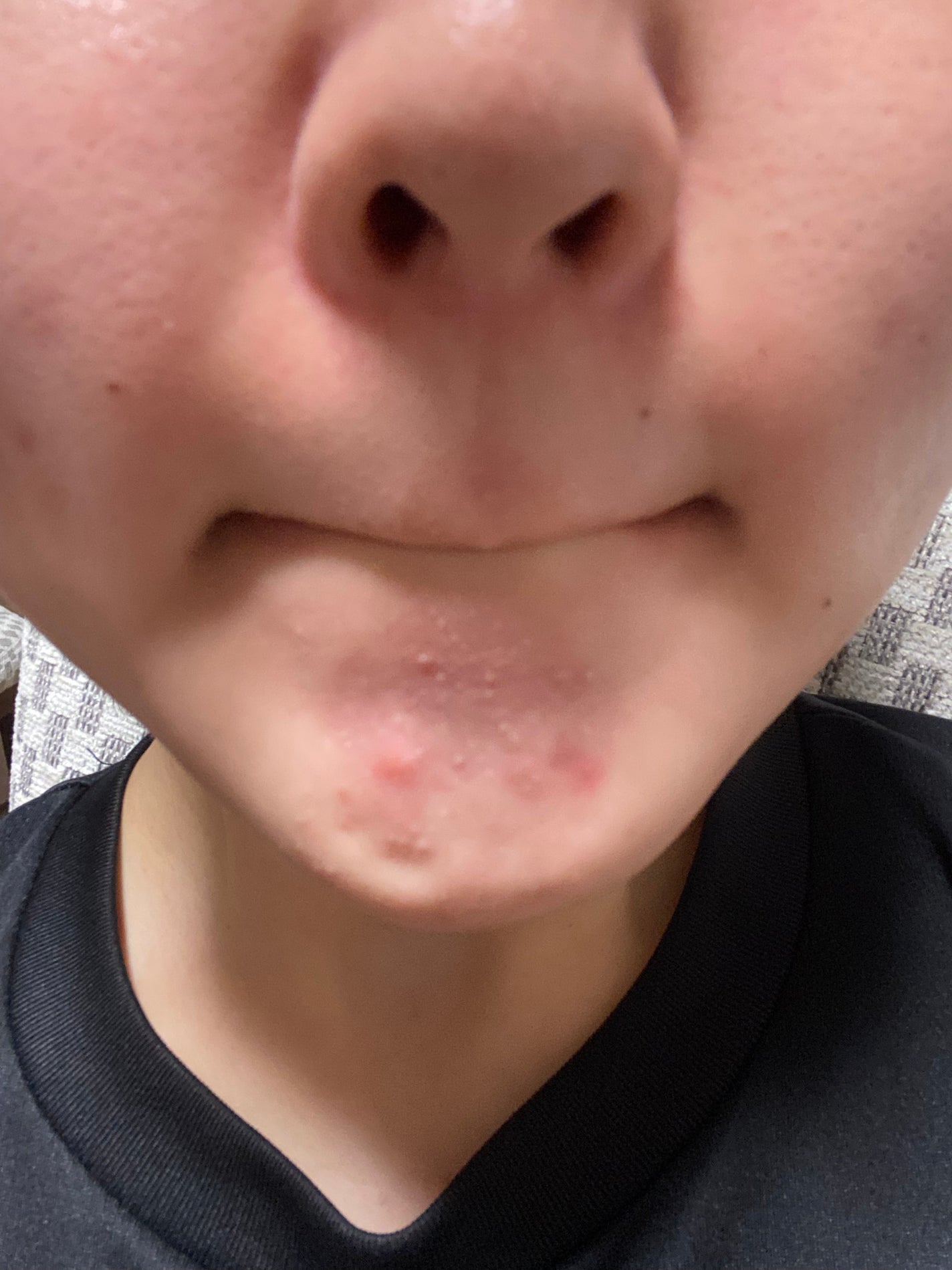 りら on LIPS 「だいぶ肌綺麗になったなぁ…(まだ全然ニキビできるし、ニキビ跡と..」(3枚目)