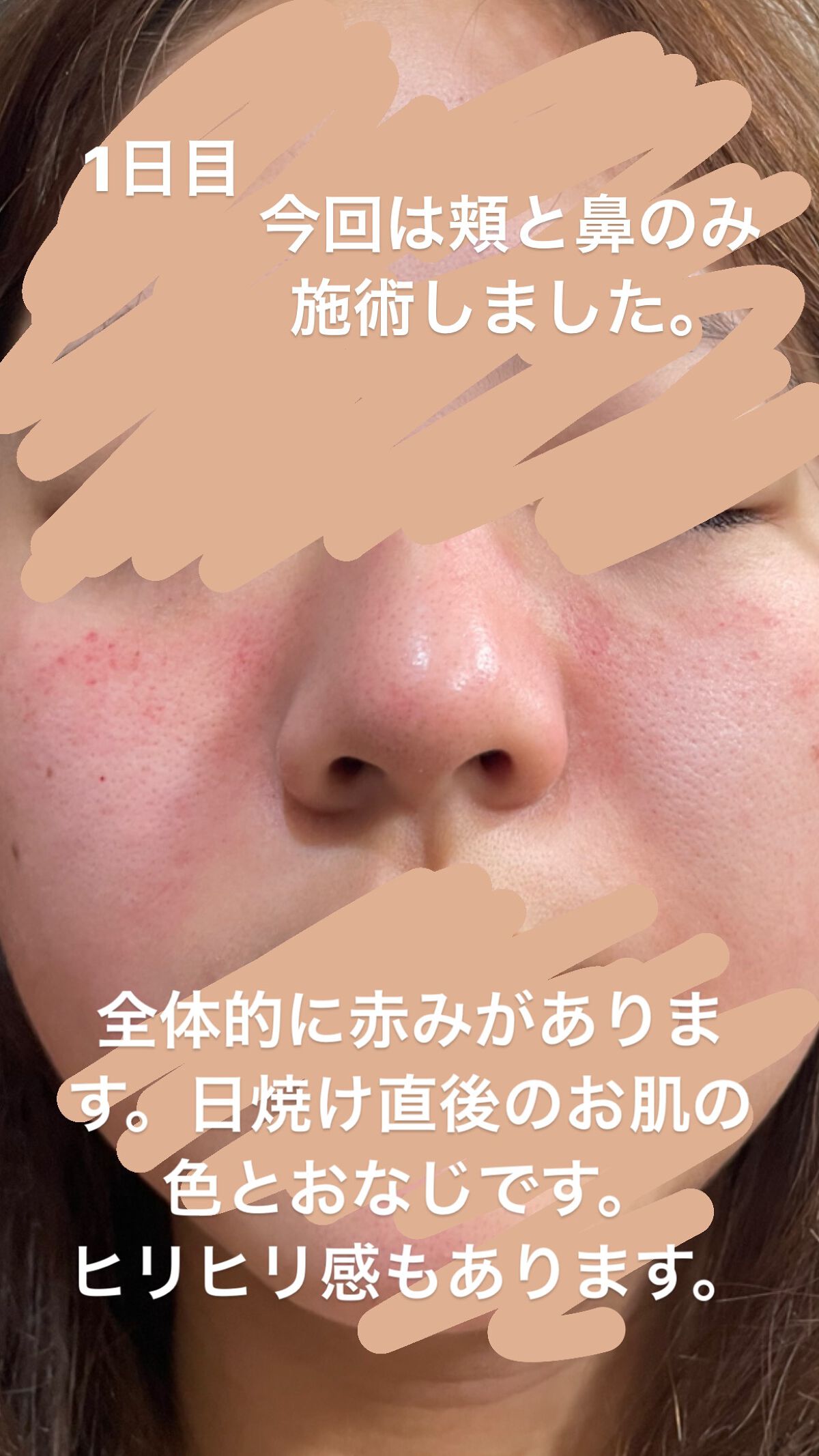 まなみ on LIPS 「ダーマペン4毛穴やクレーターなどに効く美容医療です。私は毛穴の..」(2枚目)