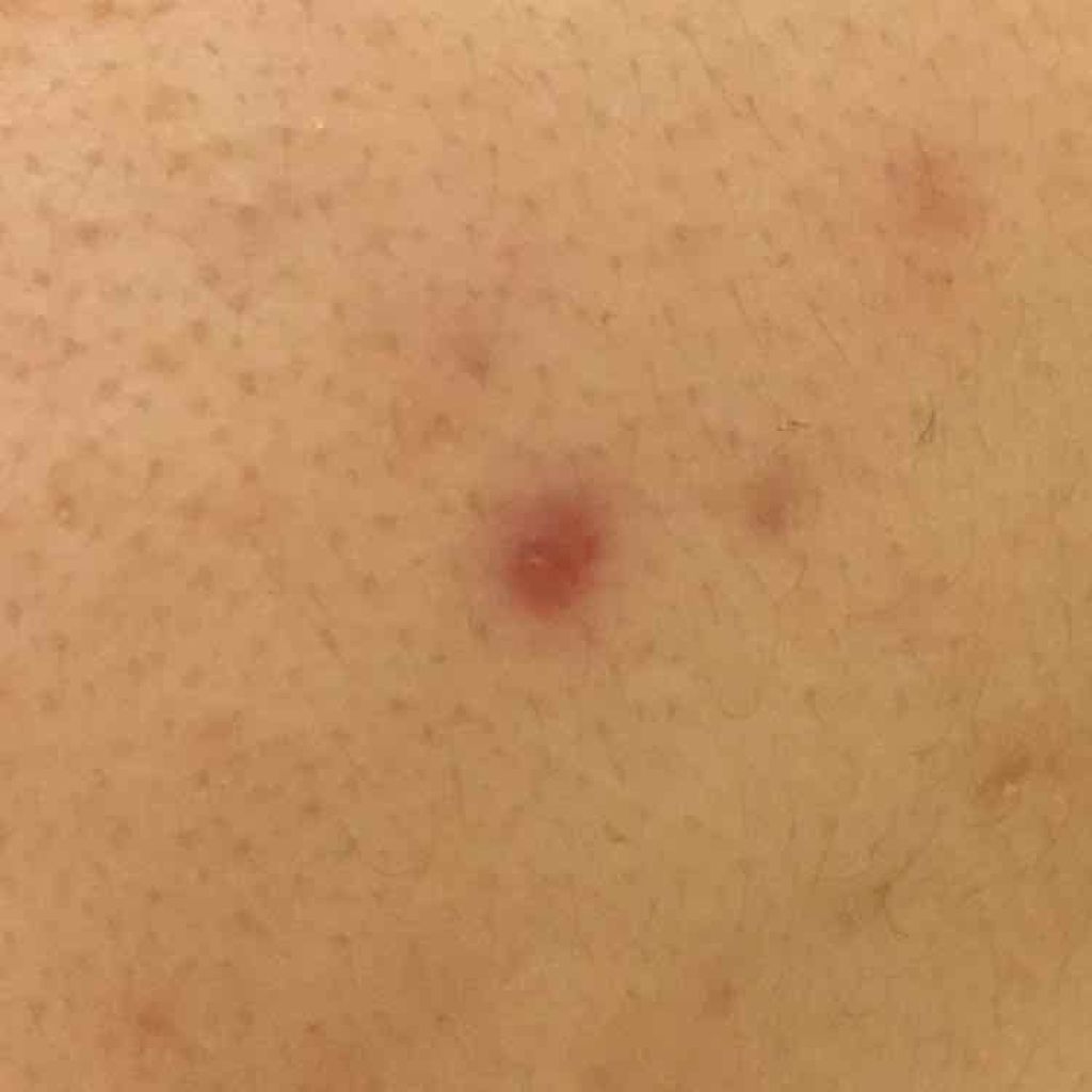 薬用 しみ 集中対策 美容液/メラノCC/美容液を使ったクチコミ(2枚目)