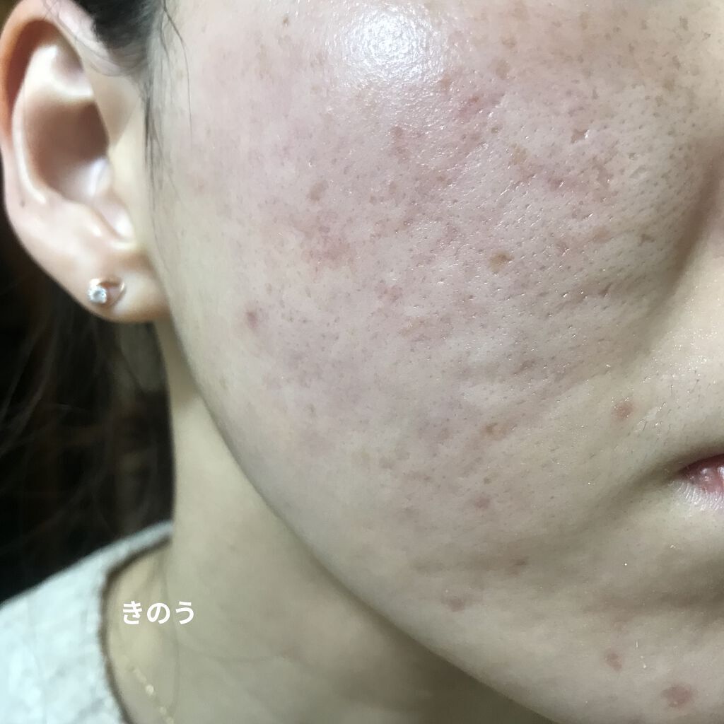 ラディアントクリーミーコンシーラー/NARS/リキッドコンシーラーを使ったクチコミ（3枚目）