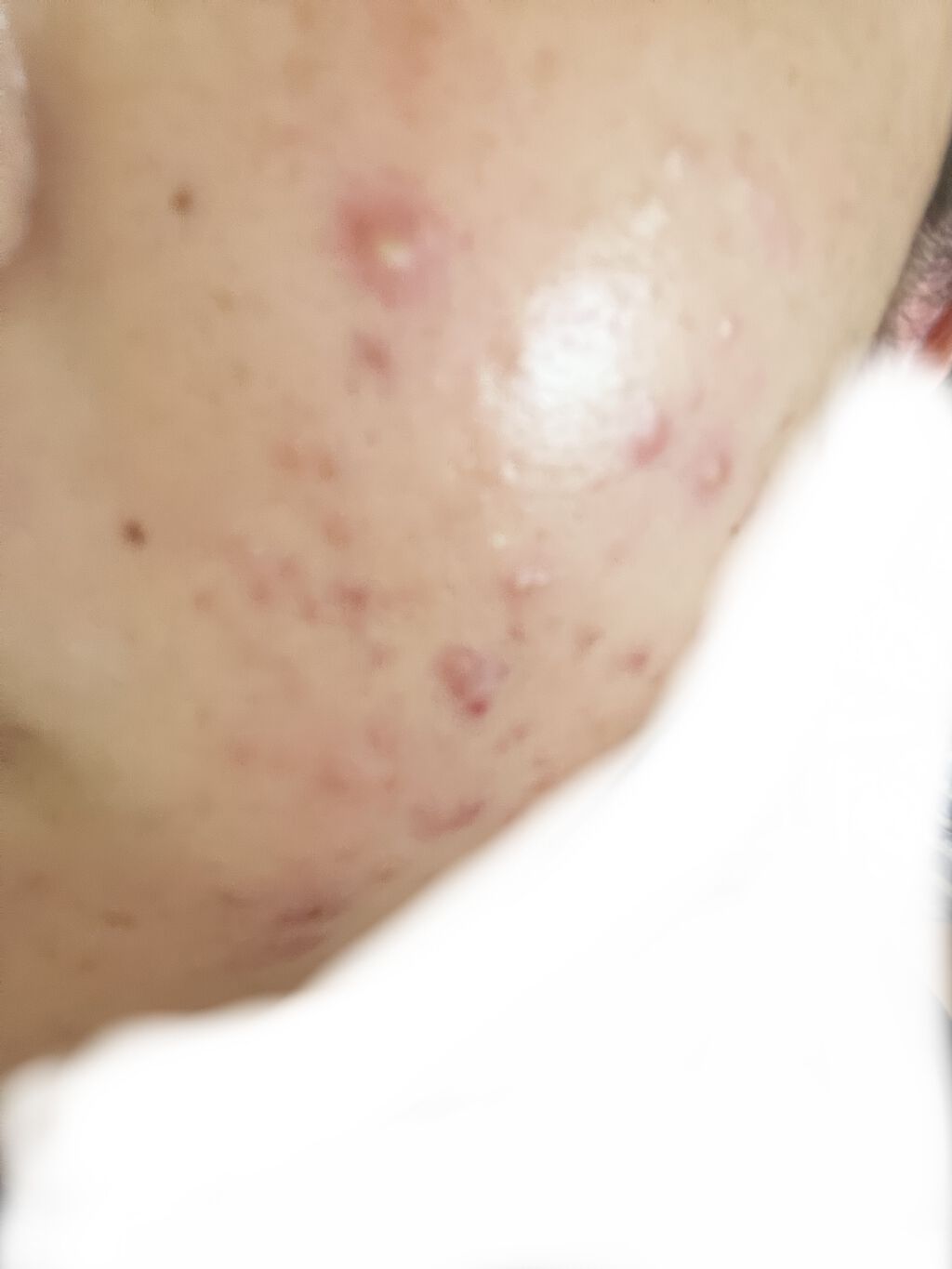 デュアック配合ゲル/ポーラファルマ/その他を使ったクチコミ（1枚目）