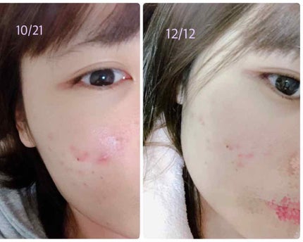 薬用 しみ 集中対策 美容液/メラノCC/美容液を使ったクチコミ(1枚目)