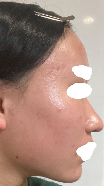 ほっくほく on LIPS 「#正直レポ#スキンケア#ディフェリンゲル#ニキビ_皮膚科またま..」(5枚目)