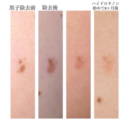 業務用ハイドロキノン/旭研究所/その他スキンケアを使ったクチコミ(1枚目)