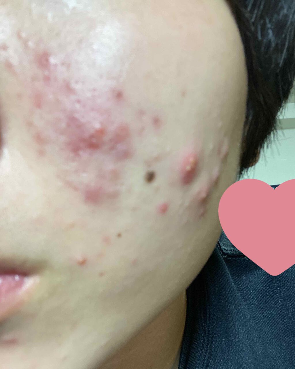 のの on LIPS 「閲覧注意です⚠️約3年間ニキビが治らないです。誰か治る方法を教..」(1枚目)