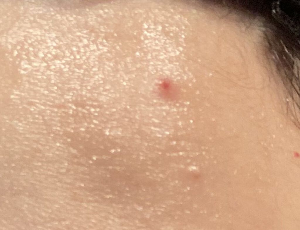 ピンプルクリア/IPSA/美容液を使ったクチコミ（2枚目）