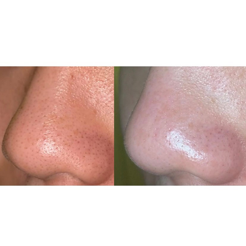 ディープクリーンマスター/ilso/その他スキンケアグッズを使ったクチコミ(1枚目)