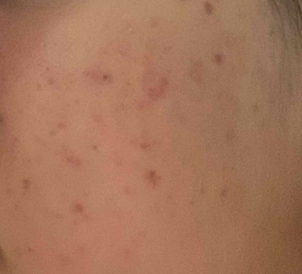 ちーず on LIPS 「皮膚科に通い続けて4ヶ月ほど…ここまでよくなりました!新しいニ..」(3枚目)