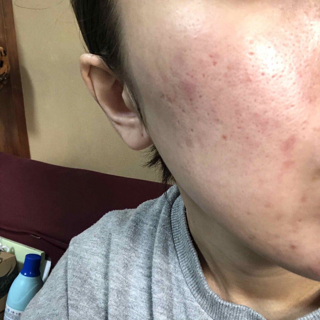 オロナインH軟膏 (医薬品)/オロナイン/その他を使ったクチコミ(2枚目)