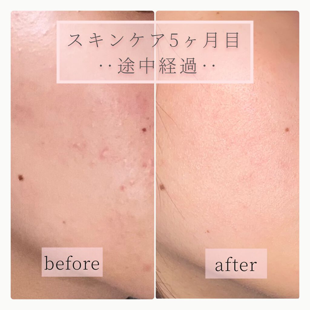 ハトムギ化粧水(ナチュリエ スキンコンディショナー R )/ナチュリエ/化粧水を使ったクチコミ（1枚目）