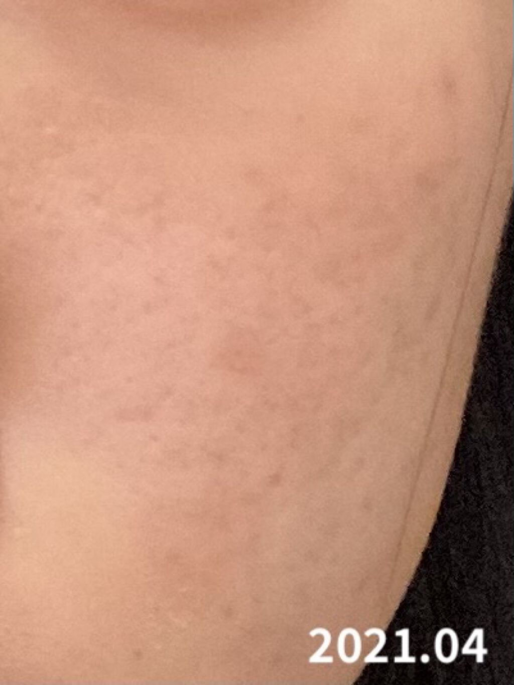 スキンピールバー ティートゥリー/サンソリット/洗顔石鹸を使ったクチコミ（3枚目）