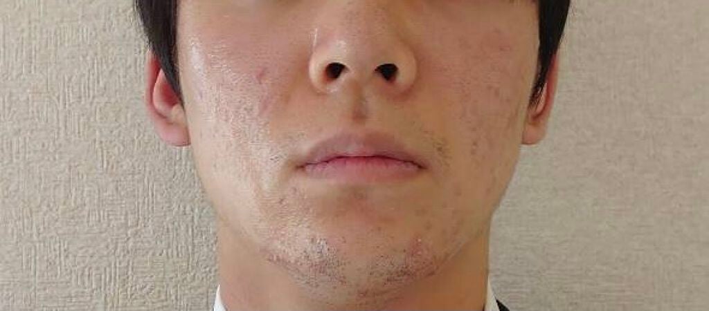 かとう on LIPS 「8/3メモ証明用の写真撮ってみて、去年の12月と比較して感激…..」(2枚目)
