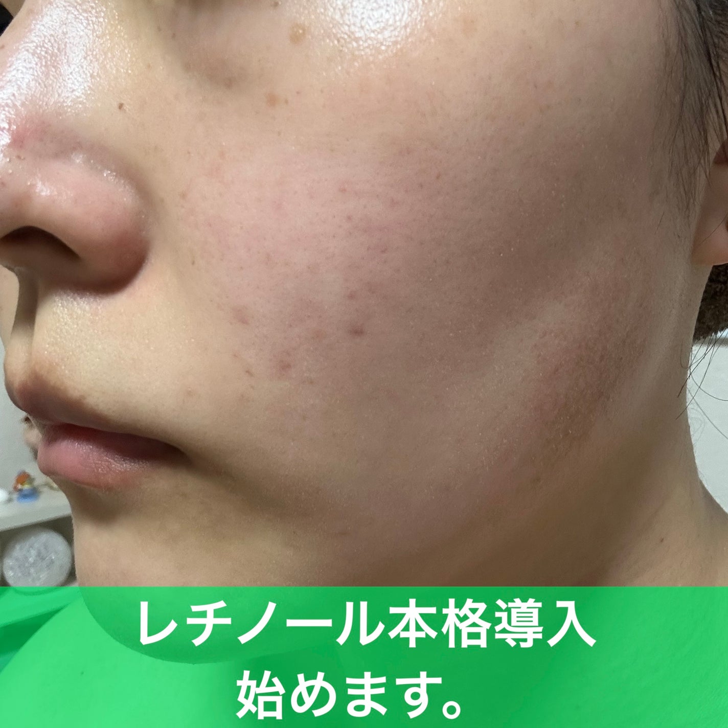 RXザ・レチノール0.1クリーム/COSRX/フェイスクリームを使ったクチコミ(1枚目)