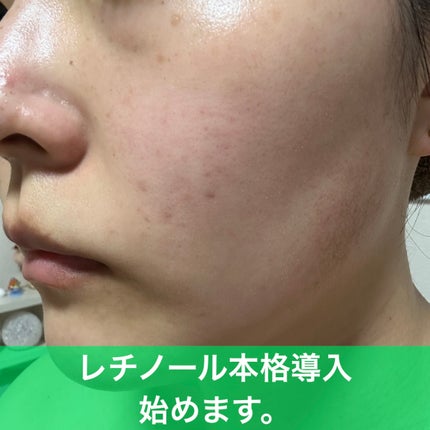 RXザ・レチノール0.1クリーム/COSRX/フェイスクリームを使ったクチコミ(1枚目)