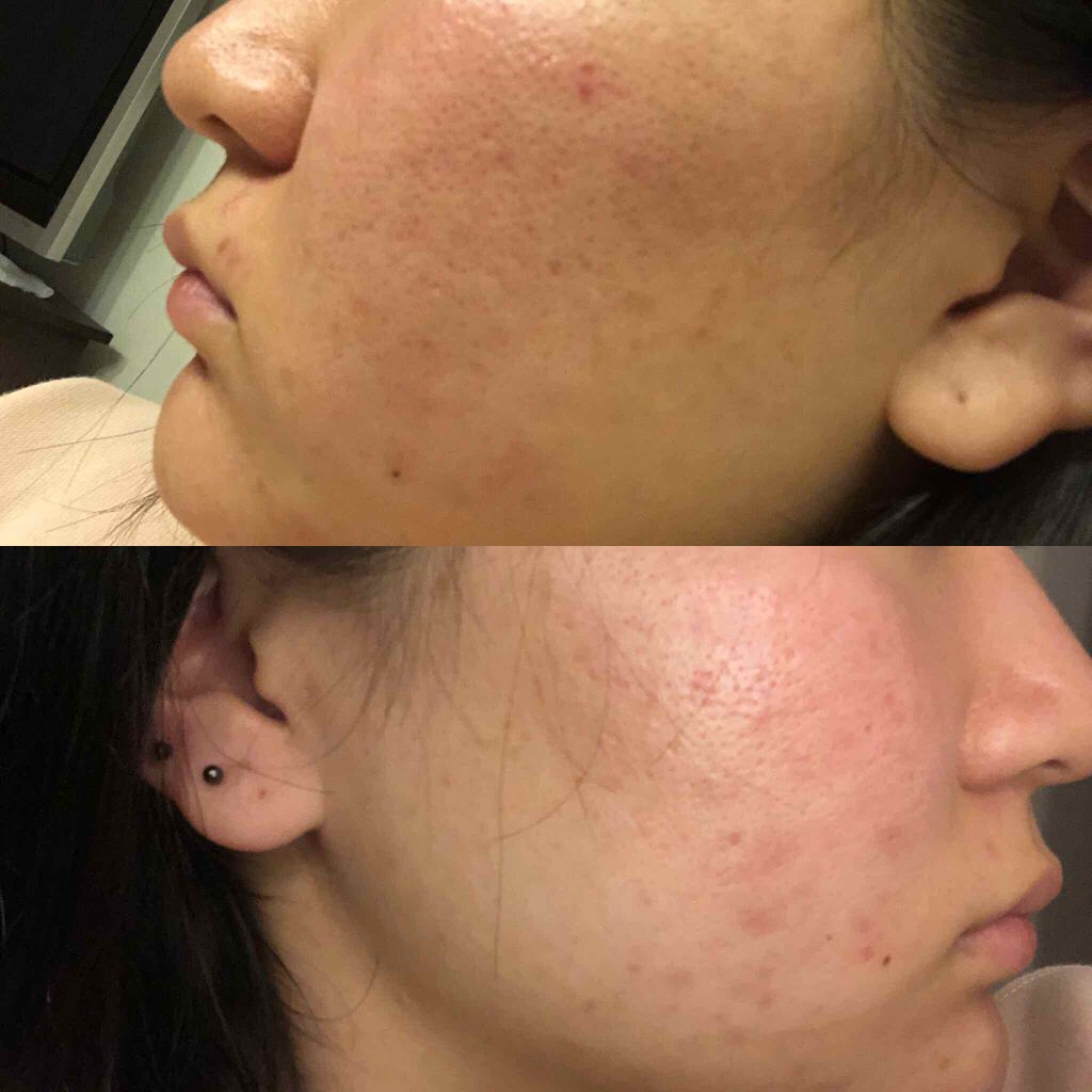 ヒルドイドローション 0.3% 50g/マルホ株式会社/その他を使ったクチコミ（2枚目）