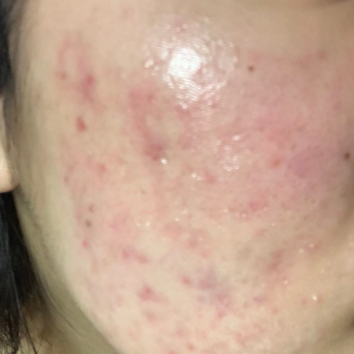 ほるもん on LIPS 「助けてください!!!!😭ニキビ跡の赤み、クレーターになってるの..」(1枚目)