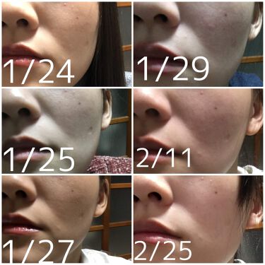 リンクルショット メディカル セラム リンクルショットの辛口レビュー 12 25 2 25までの約2ヶ月 のうち By じゃりちゃん 敏感肌 代前半 Lips