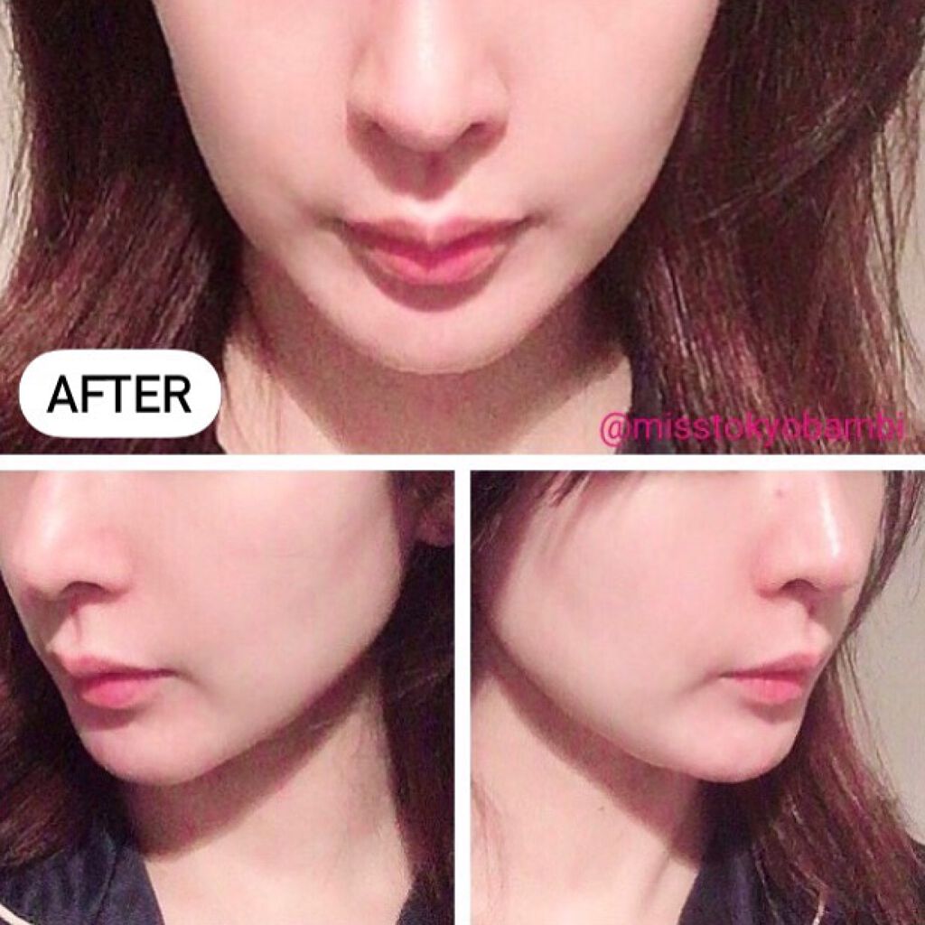 白ゆり@美容ブロガー on LIPS 「3ケ月恒例の湘南美容外科でサーマタイトニングを受けてきました..」(4枚目)