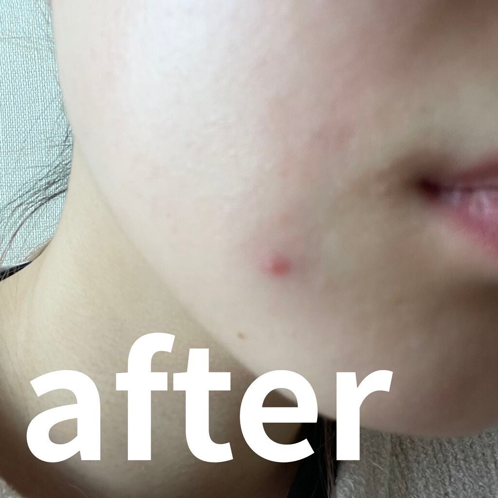 サナ ピュアテクトAC 薬用プロテクトクリーム/ピュアテクトAC/フェイスクリームを使ったクチコミ(3枚目)