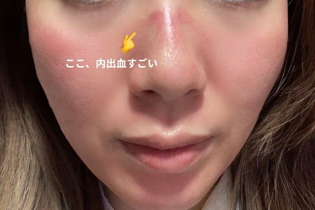 aiko on LIPS 「⚠️写真は真っ赤な肌が出てきます😣今回はコスメではなく、ここ最..」(2枚目)