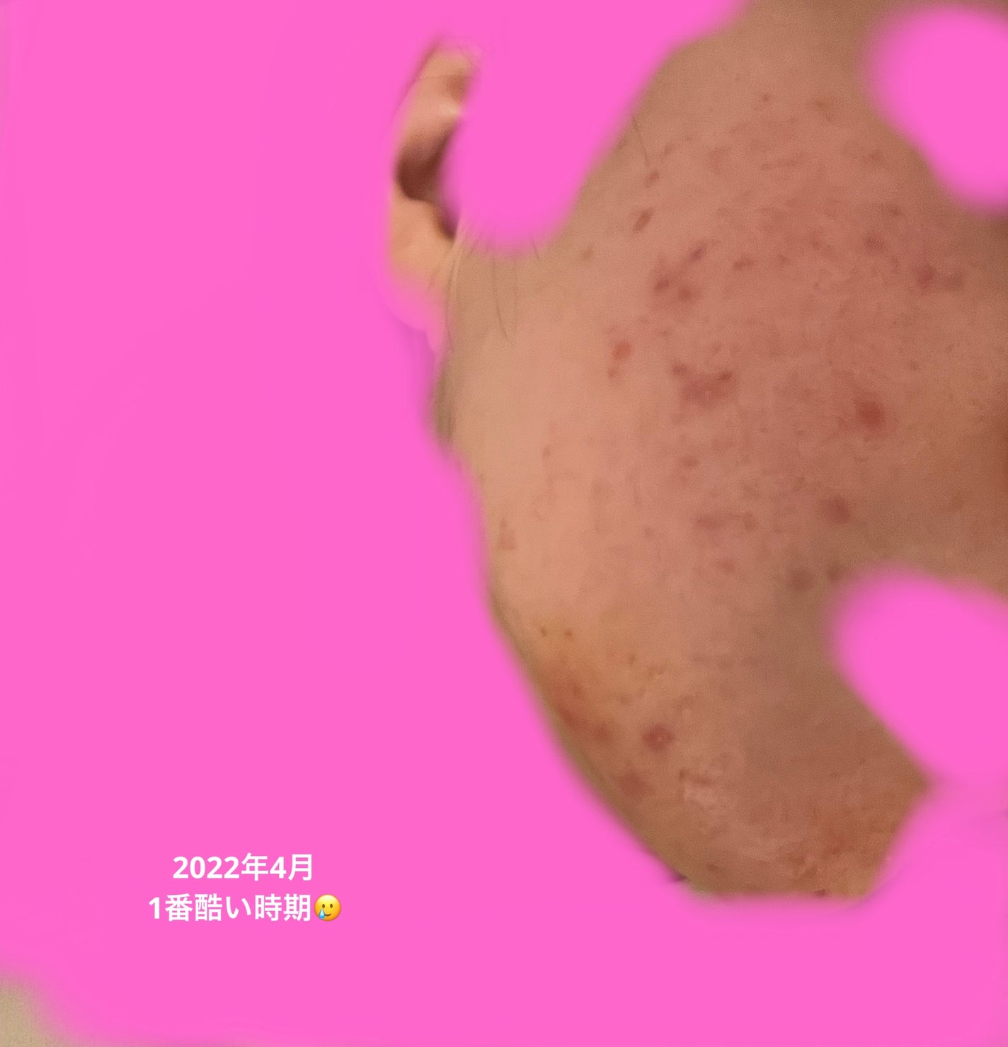 プリスクリードD(医薬品)/IHADA/その他を使ったクチコミ(3枚目)