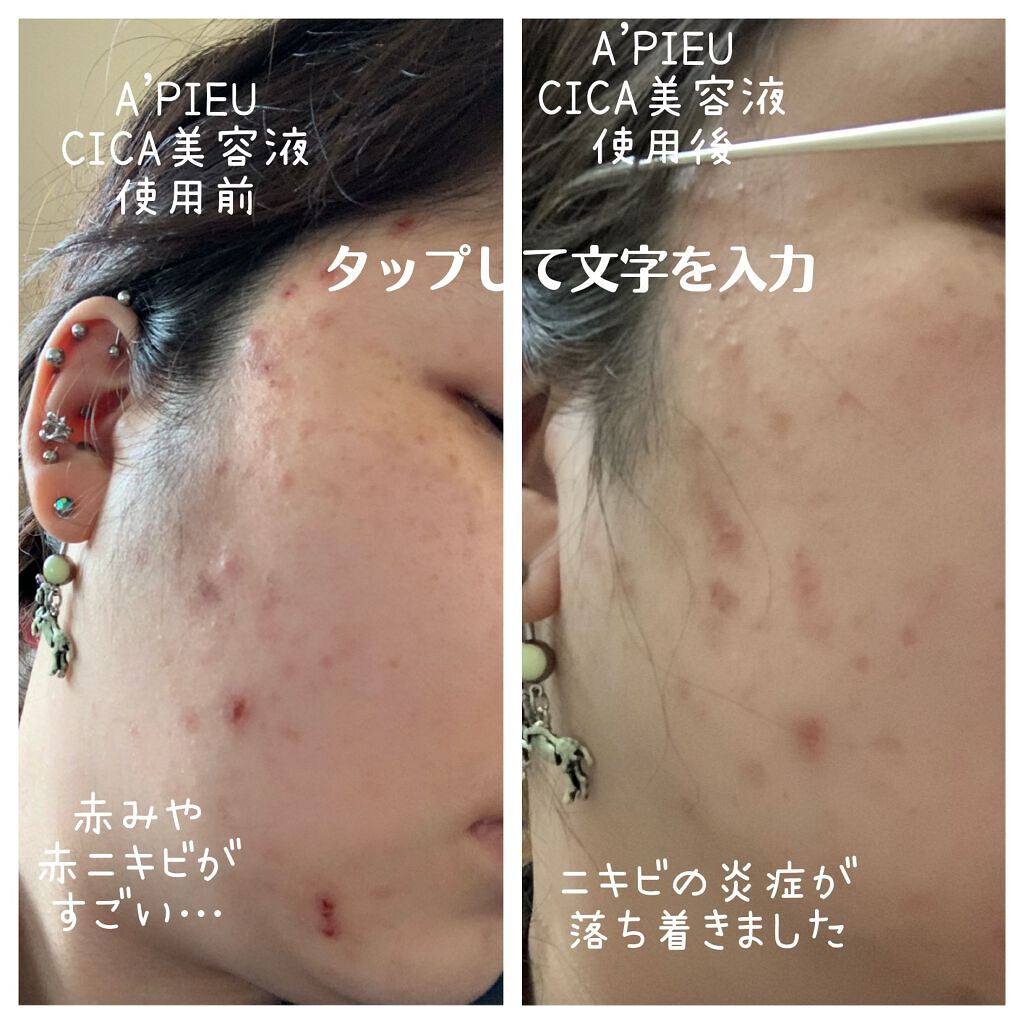 アピュー マデカソ CICAシート美容液/A’pieu/トナーパッドを使ったクチコミ（2枚目）