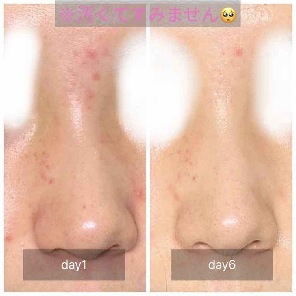 明色 美顔水 薬用化粧水 美顔を使った口コミ 2枚目注意 赤ニキビが激減しました By ゆきまる 脂性肌 代前半 Lips