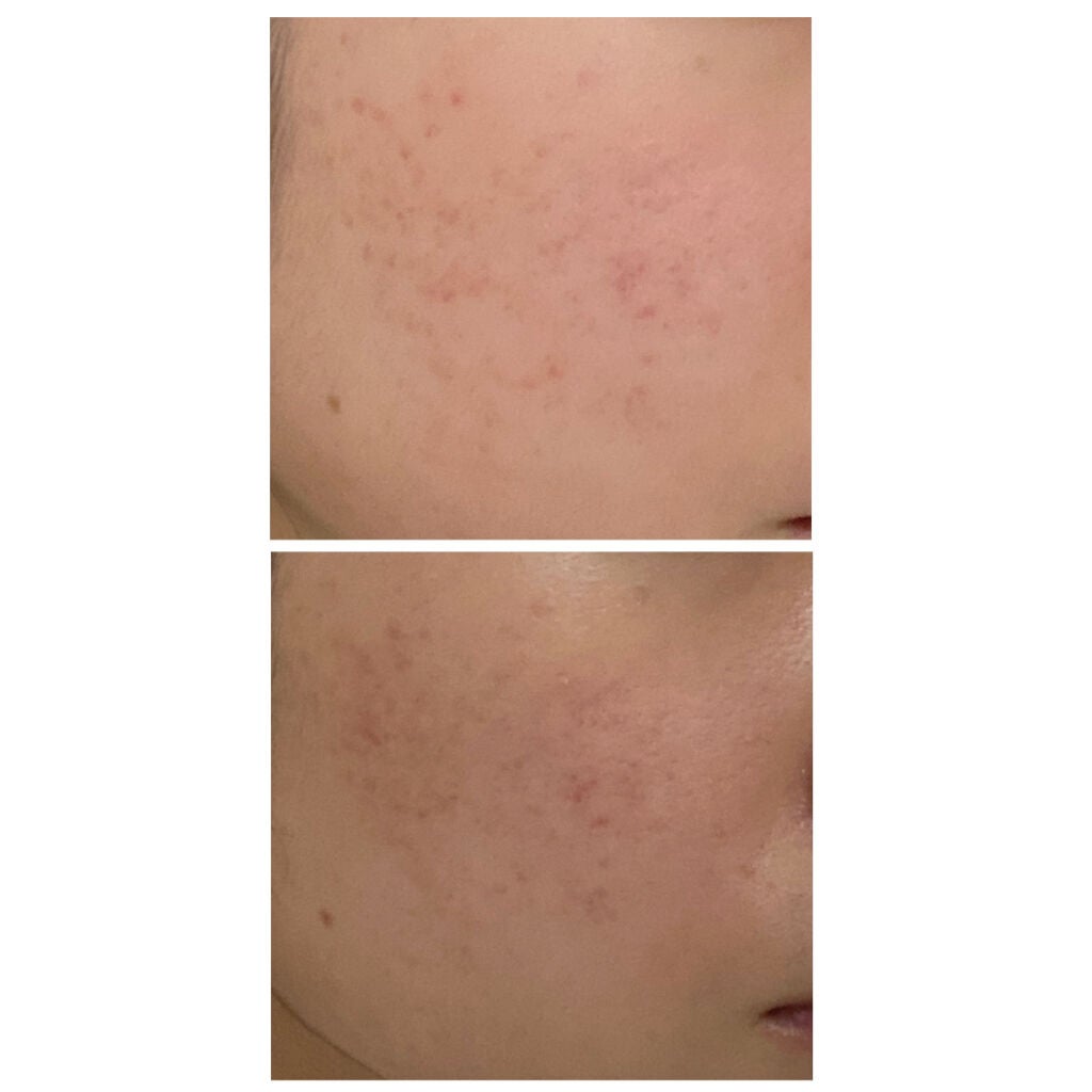 01_ringo_01 on LIPS 「上の写真が87日目、下の写真が薬を塗り始めて172日目💊最近新..」(2枚目)