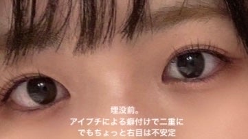 ぺこじゅん on LIPS 「【埋没法直前からダウンタイム2日目まで編】聞きたいこと、気にな..」（2枚目）