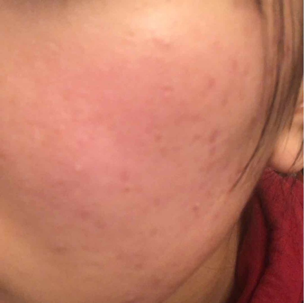 バイオイル/バイオイル/フェイスオイルを使ったクチコミ（3枚目）