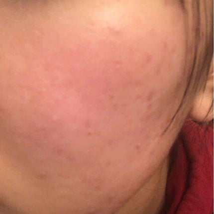 マシュマロホイップ 薬用アクネケア/ビオレ/泡洗顔を使ったクチコミ(3枚目)