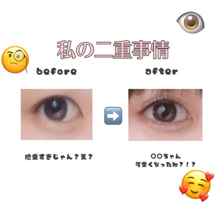 アイテープ(絆創膏タイプ、レギュラー、70枚)/DAISO/二重まぶた用アイテムを使ったクチコミ(1枚目)