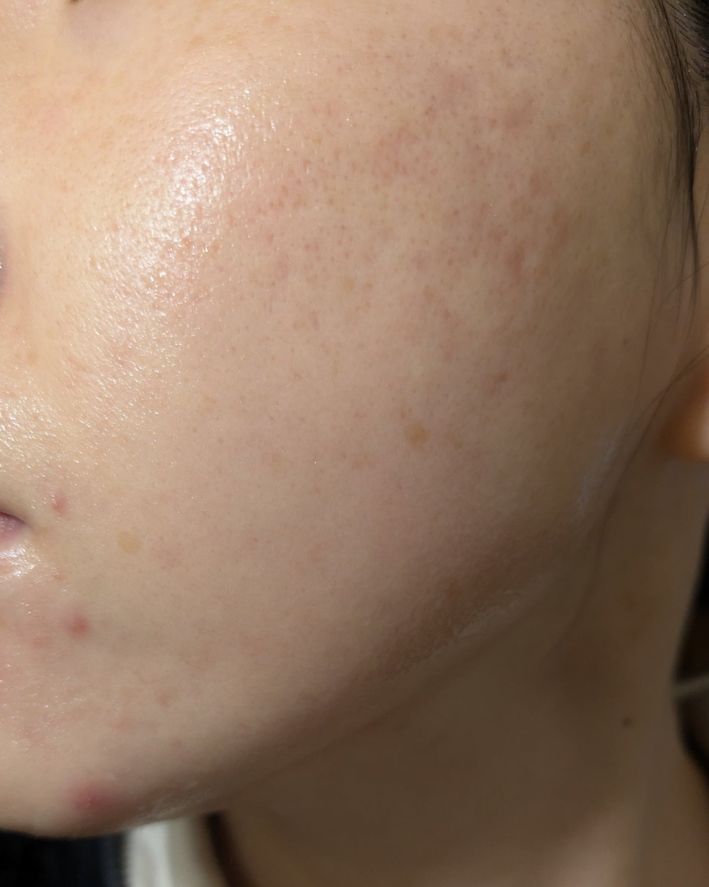 miina@汚肌工事録⚠️ on LIPS 「11/7の#汚肌工事録一気に荒れてる😳..」(2枚目)